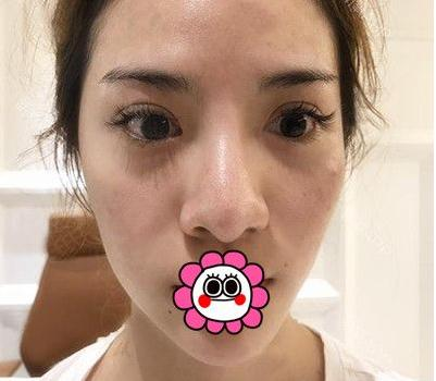 有“鼻王”之稱的楊群申做鼻子到底怎么樣？隆鼻前后圖片