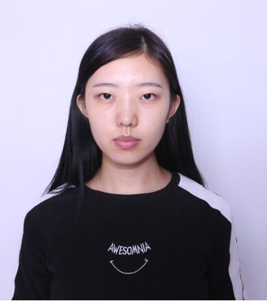 做雙眼皮案例，第四軍醫(yī)大學唐都醫(yī)院李望舟雙眼皮案例圖片
