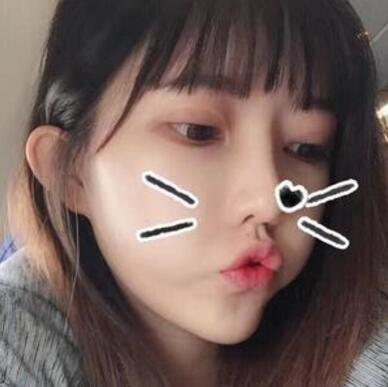 做雙眼皮案例，第四軍醫(yī)大學唐都醫(yī)院李望舟雙眼皮案例圖片