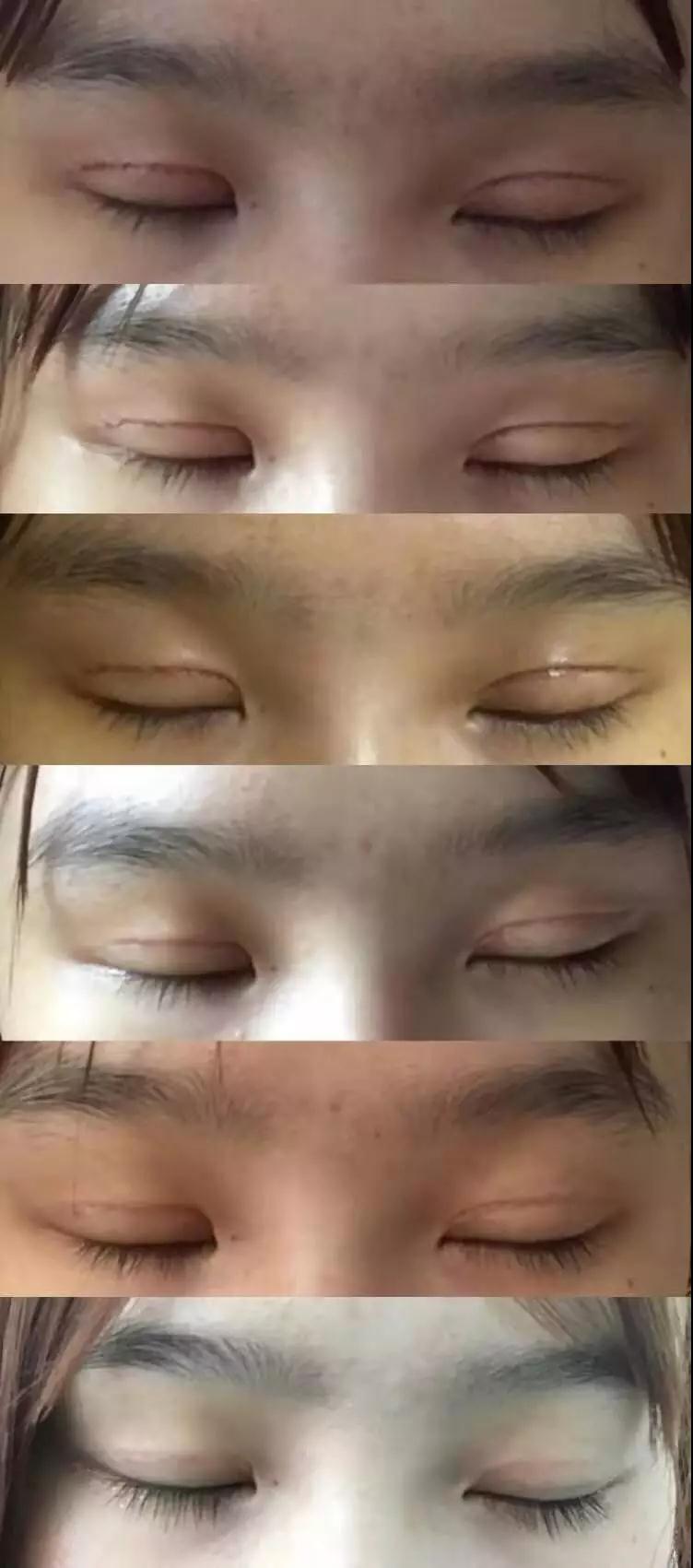濟南坤如瑪麗崔金珍雙眼皮案例術(shù)后閉眼狀態(tài)