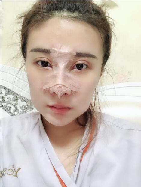 上海藝星醫(yī)療美容醫(yī)院做鼻綜合術(shù)后的第三天