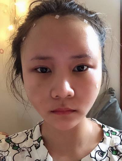 上海美萊醫(yī)療美容門診部做面部填充剛剛做完手術(shù)后的情況