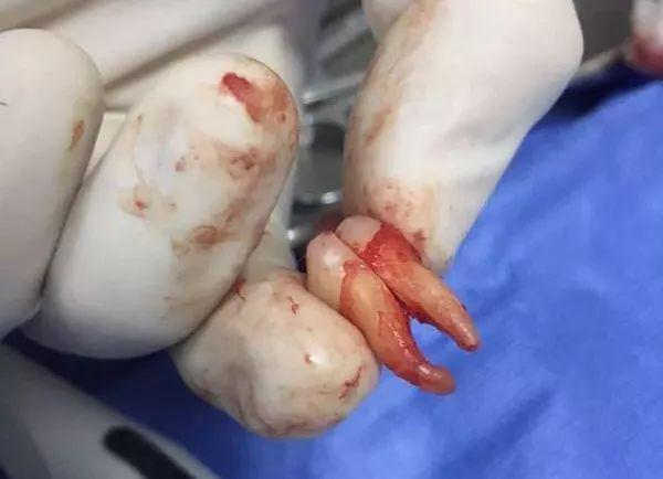 福州登特口腔拔智齒有哪些利弊？拔智齒有哪些情況？