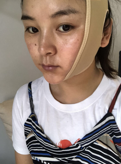 上海東方麗人美容醫(yī)療醫(yī)院李哲面部吸脂案例效果分享