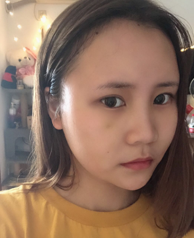 上海美萊醫(yī)療美容門診部做面部填充術(shù)后的日?；謴?fù)
