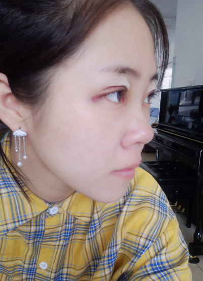北京東方瑞麗醫(yī)療美容門診部做雙眼皮剛剛做完手術(shù)
