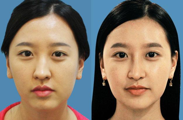 面部不對稱可以怎么矯正？臉一邊大一邊小怎么矯正？