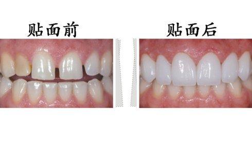 東莞拜博口腔瓷貼面有什么優(yōu)勢？瓷貼面有副作用嗎？