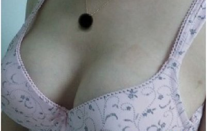 上海美萊醫(yī)療美容門診部做假體隆胸術(shù)后無鋼圈內(nèi)衣