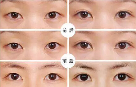 貴州旭美人整形埋線雙眼皮優(yōu)點(diǎn)有哪些如何選擇？