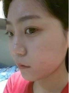 上海時光整形外科醫(yī)院做耳軟骨隆鼻手術前