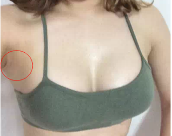 南京美貝爾醫(yī)療美容醫(yī)院做假體隆胸手術后的一個月