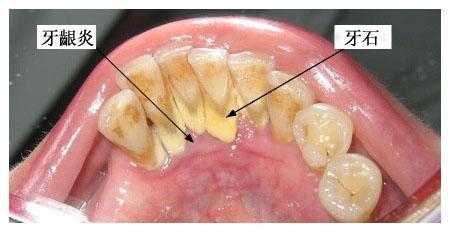  廣州柏德口腔牙齦炎怎樣治療吃什么消炎藥？