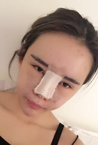 上海伊美爾港華醫(yī)療美容醫(yī)院劉坤自體肋軟骨隆鼻案例效果分享