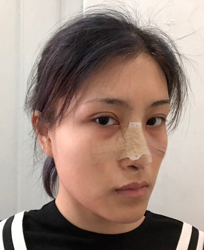 上海港華醫(yī)療美容醫(yī)院做隆鼻剛剛結(jié)束手術(shù)