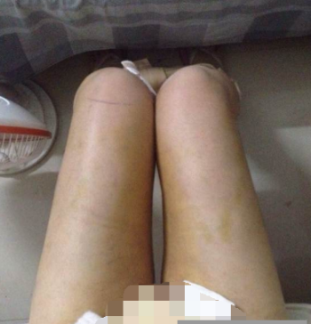  東莞華美醫(yī)療美容醫(yī)院做大腿吸脂手術(shù)后的一個月
