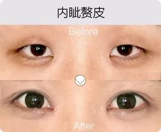 哈爾濱成美整形內(nèi)眥贅皮矯正怎么樣有哪幾種手術(shù)方法？