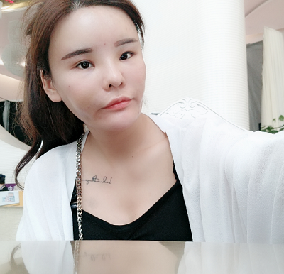 上海美萊醫(yī)療美容門診部做面部填充手術(shù)后的日?；謴?fù)
